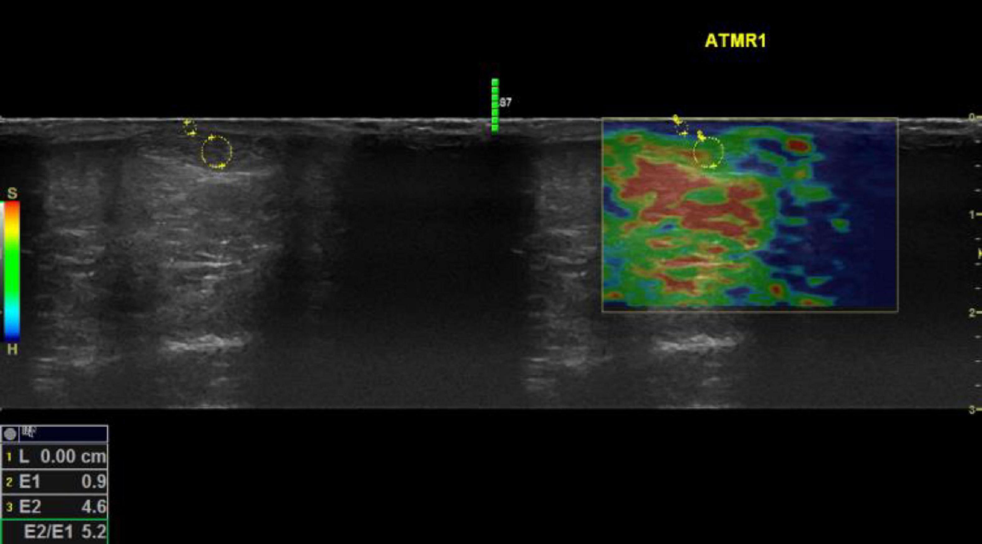 Biomechanical changes in the gastrocnemius medius–Achilles tendon complex in people with hypermobility spectrum disorders: A cross-sectional compression sonoelastography study